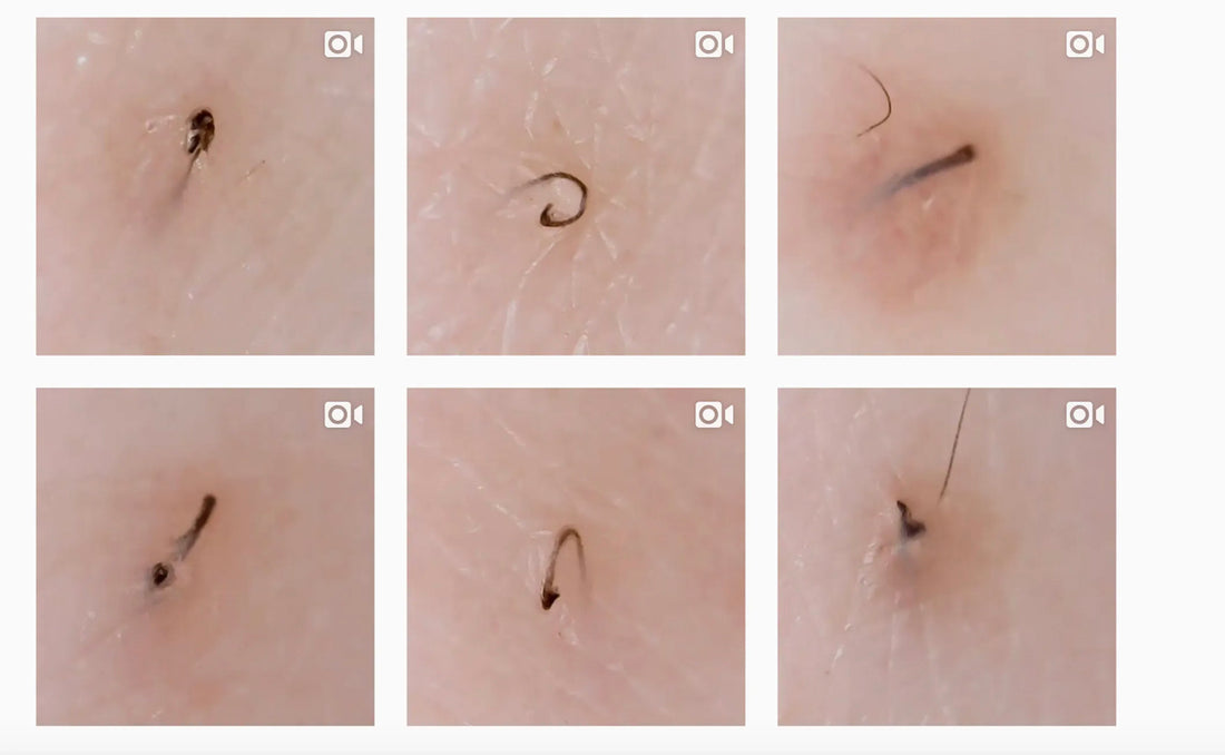 INGROWN HAIR