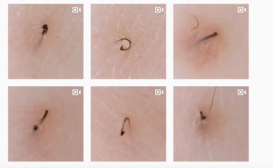 INGROWN HAIR