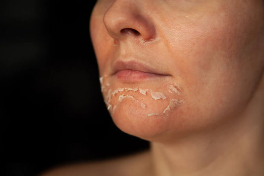 Chemical Peel Aftercare: 10 Dos and Don’ts