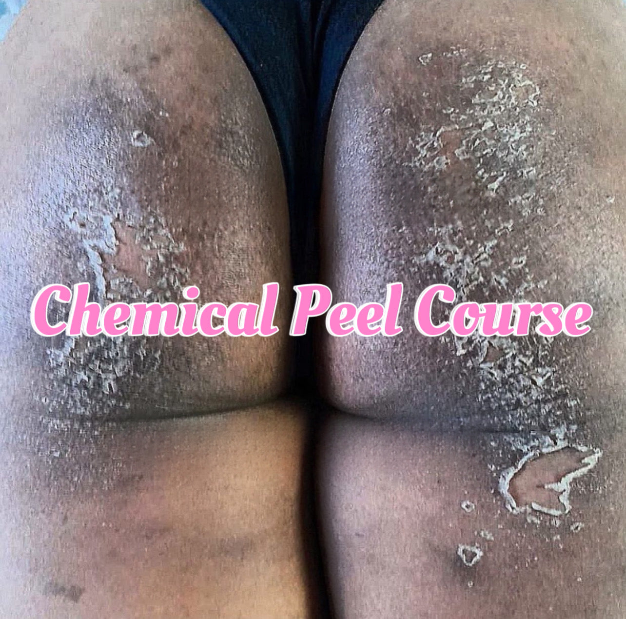 Chemical Peel 1 on 1 Course